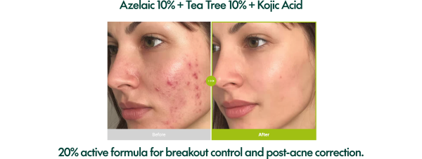 سرم آزلائیک اسید 10 کوجیک و درخت چای پوریتو - تصویر 7